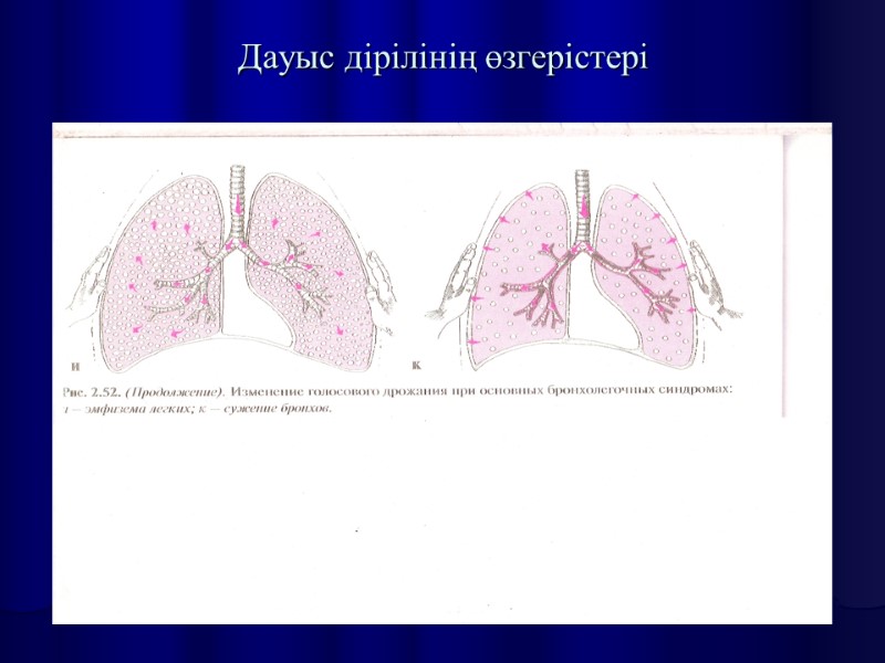 Дауыс дірілінің өзгерістері